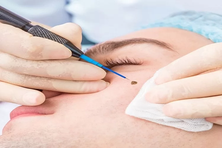 Mole removal with laser 1
